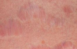 Raudonos juostelės ant odos kaip įbrėžimai