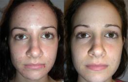 Median chemical peel - before and after photos